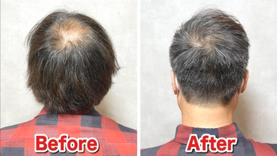 SNS再生数300万回突破！男性向け薄毛専門美容室「RELIVE」、 施術ビフォーアフター事例の公式ポートフォリオを公開
