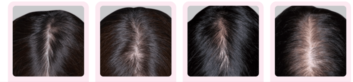 分け目の透け感(壮年性脱毛症)の頭髪写真