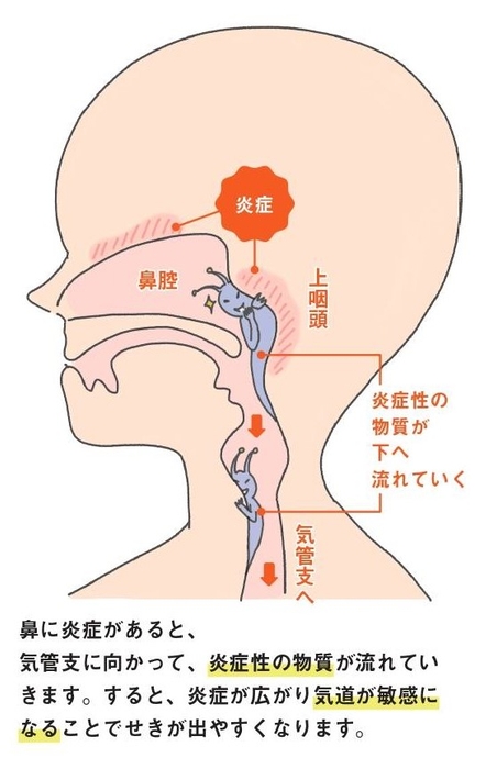 炎症性の物質がのどから流れ、気管支に影響をおよぼす