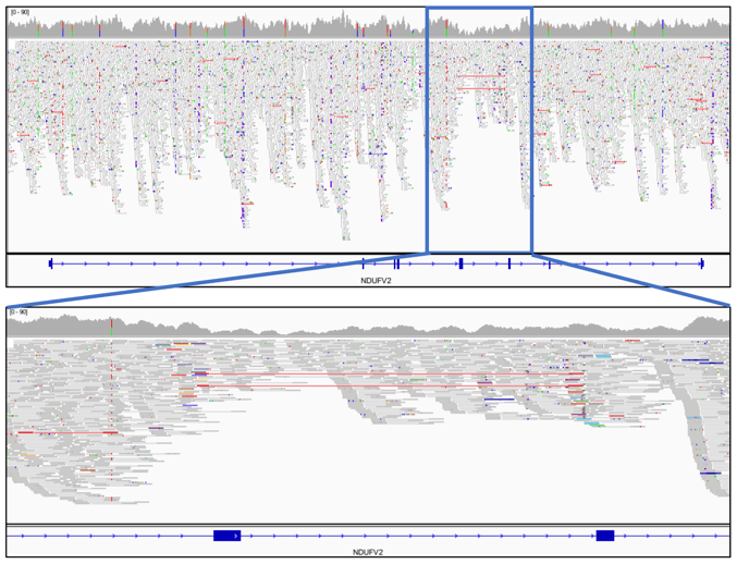 図3 全ゲノム解析によるNDUFV2遺伝子欠失の同定: 全ゲノム解析データからイントロン4-エクソン5-イントロン5の領域にシーケンスカバレッジの減少が確認され、欠失の存在が示唆されました。
