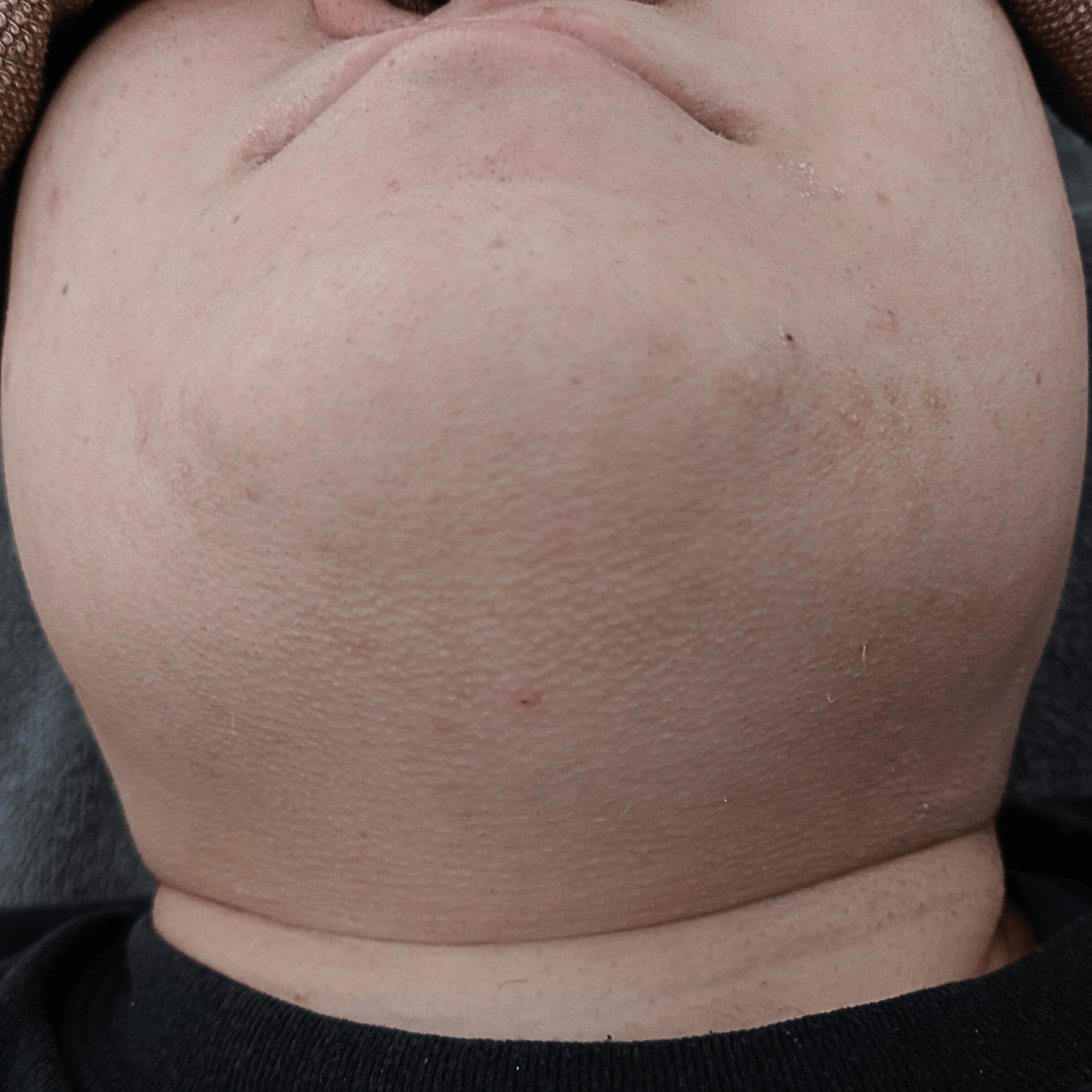 ツルツルのヒゲ画像