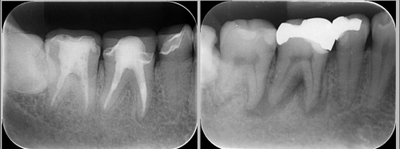 右が２０１５年ご来院時の治療前のレントゲン写真。黒く影になっているところが病変。左が２０２５年、一時帰国時の定期健診のレントゲン写真。溶けていた骨が再生されたために、根の先の黒い影が消失している。