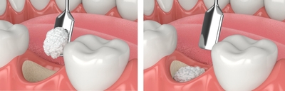 幹細胞培養上清液した骨再生インプラント治療