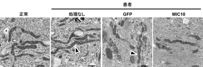 図4　クリステ形成の異常　患者由来線維芽細胞を電子顕微鏡により観察することで、クリステ形成の異常を観察しました（矢印）。また、MIC10を細胞に戻すことで、この異常は回復されました。