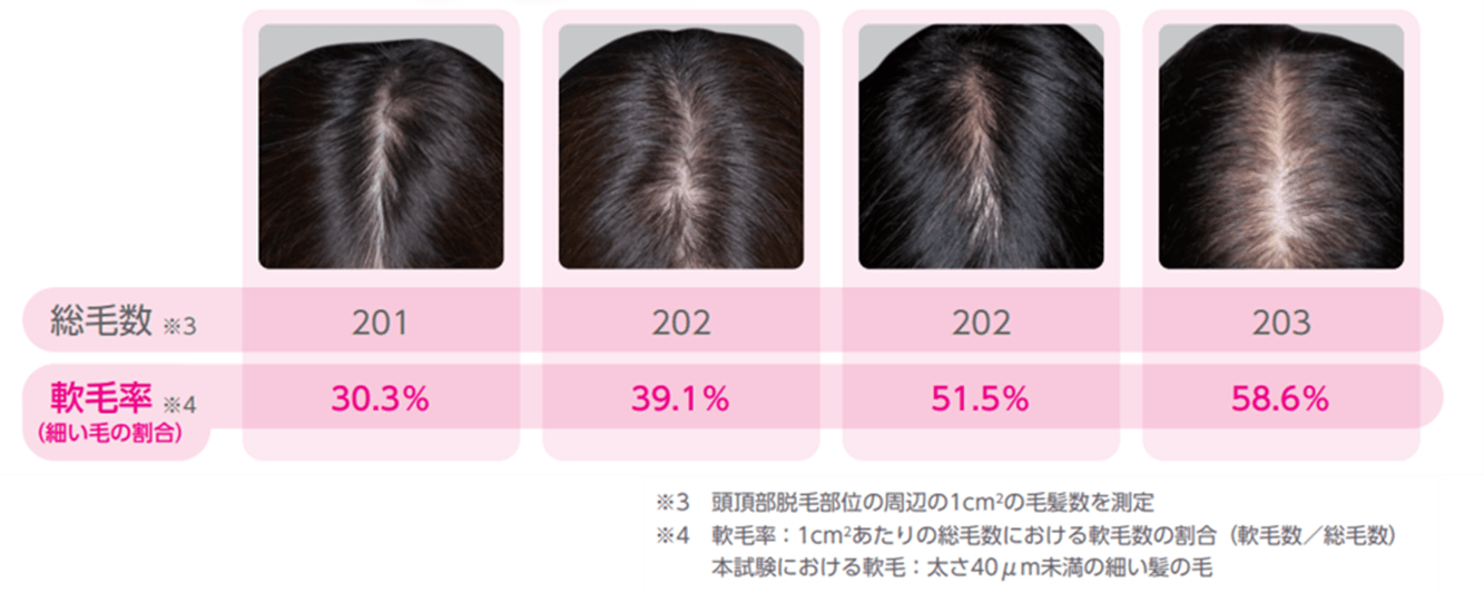 壮年性脱毛症の頭髪写真