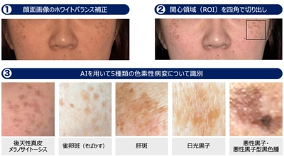AIを用いた顔のシミの高精度診断支援システム開発に成功　レーザー治療実施判断を支援し、治療の最適化に期待