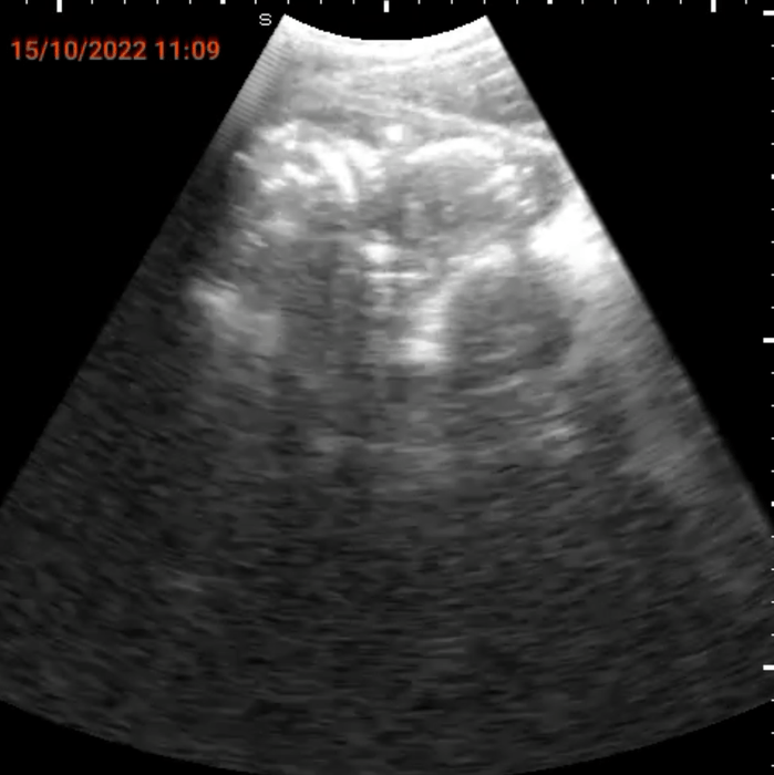 SPAQで発見された子宮外妊娠画像