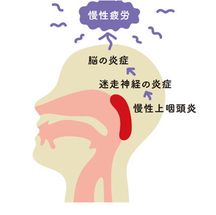 「慢性疲労」は、脳の炎症、迷走神経の炎症がもたらす病気です