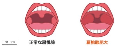 扁桃腺イメージ図