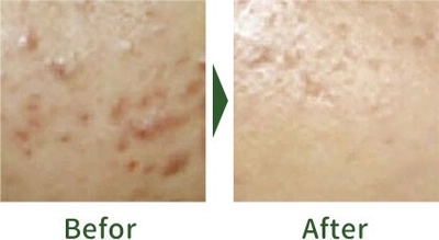 痛くない、剥離しない、ダウンタイムなし アマロス ハーブピーリング ！