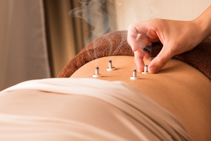 日本鍼灸オプションのイメージ
