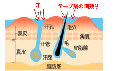 汗による汗管の詰まり