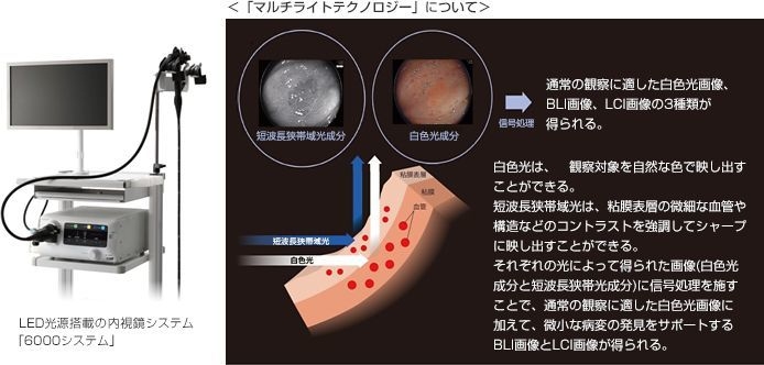 画像強調機能で、内視鏡による微小な病変の発見をサポート LED光源搭載