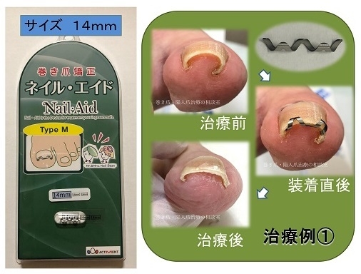 専門医師が開発した巻き爪矯正器具「ネイルエイド」で 2万人以上