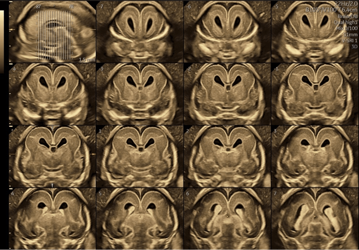 胎児脳の診断はここまで精密な画像で行わなければならないと夫医師は話す