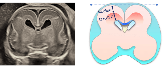 胎児脳サブプレート研究