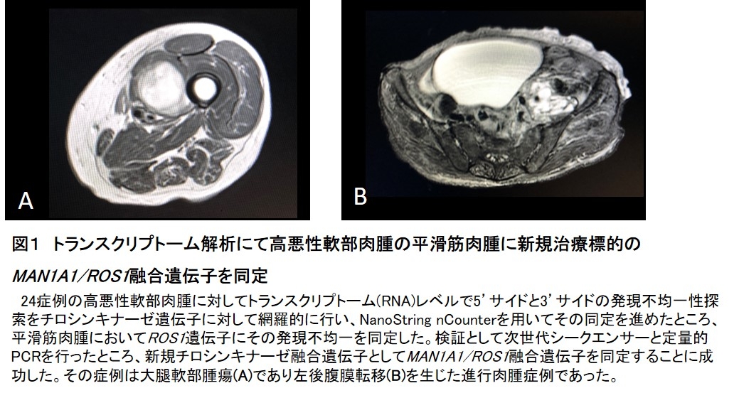 図1 トランスクリプトーム解析にて高悪性軟部肉腫の平滑筋肉腫に新規治療標的のMAN1A1/ROS1融合遺伝子を同定