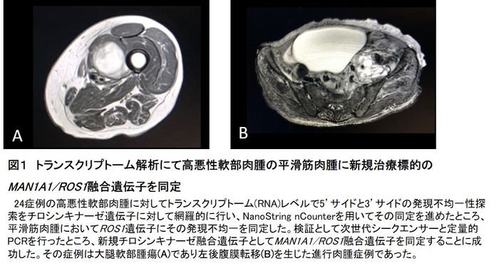 図1 トランスクリプトーム解析にて高悪性軟部肉腫の平滑筋肉腫に新規治療標的のMAN1A1/ROS1融合遺伝子を同定