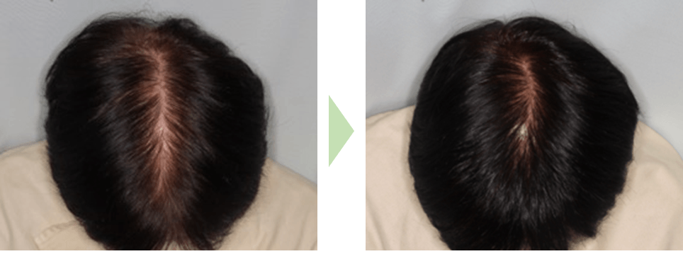 使用前→使用後(60代女性/3ヶ月使用)