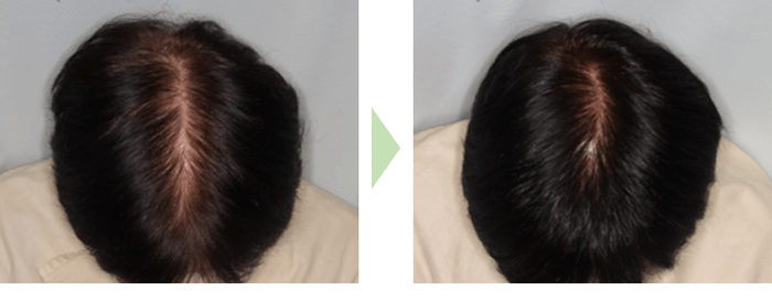 使用前→使用後(60代女性/3ヶ月使用)