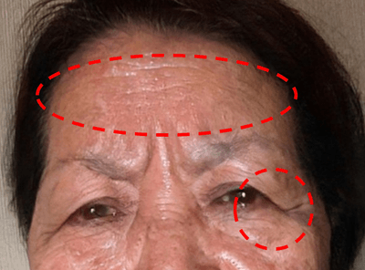 額、目元のシワ