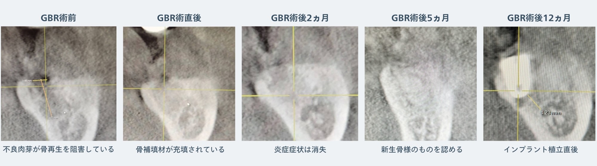 GBRからインプラント植立までのCBCT画像