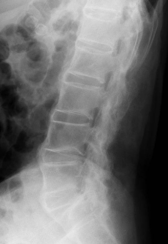 図1:強直性脊椎炎の脊椎レントゲン写真