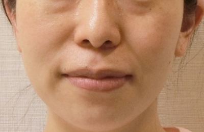 治療前は、向かって左側の噛む筋肉の緊張が強く、そちら側の顔半分は全体に上がっているが、反対側は下がった印象がみられる