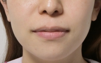 矯正治療後。左右のアンバランスが改善されている。