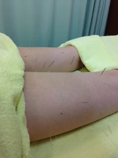 鍼 施術イメージ