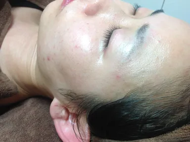 おでこの産毛アフター