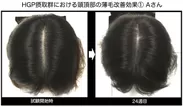 HGP摂取群における頭頂部の薄毛改善効果(1) Aさん
