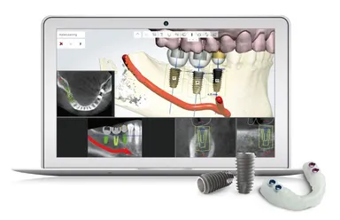 CADデータを使った術前の計画と3Dプリンターで作ったサージカルガイド
