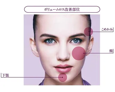 「ジュビダームビスタ(R) ボリューマ XC」による治療の適用となる部位