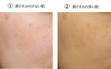 肌のくすみ