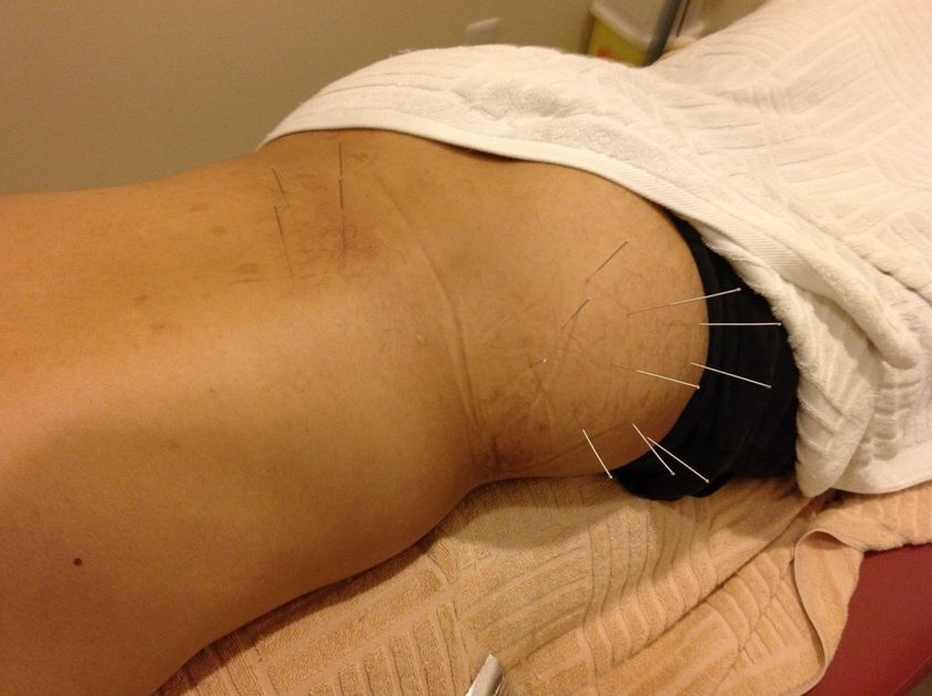 10年間で100万本突破！お尻に最大9cm刺す針治療
「ロングストローク針治療」来院者が3,000人を突破