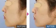 頬のリフトアップ効果が見られる術後イメージ