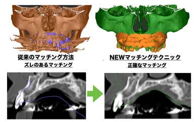 3Dガイド技術(従来の術式との違い)