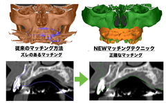 インプラントの3Dガイド技術で特許を取得