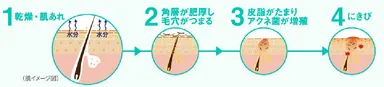 乾燥からはじまるにきびのメカニズム