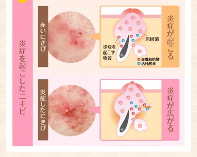 赤ニキビが悪化すると膿を持つ