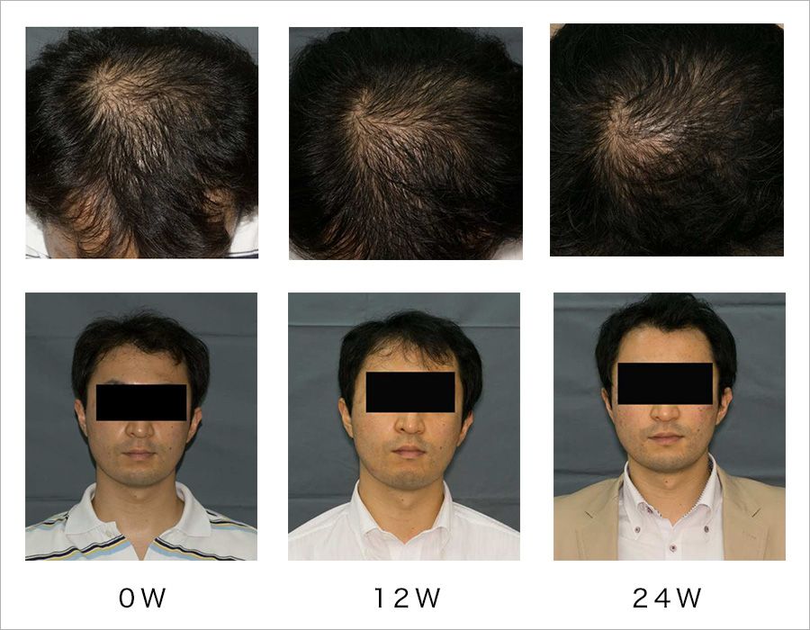 薄毛男性向け育毛剤(化粧品)のフィンジア、臨床試験にて育毛効果が見られた結果を報告｜株式会社ユーピーエスのプレスリリース