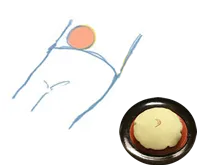 草もち温灸【へそ】