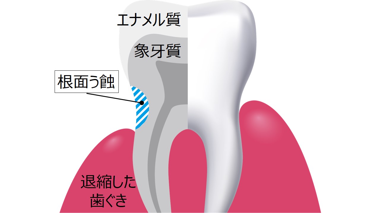 クリニカから 大人のための予防歯科 を提案 クリニカアドバンテージnext Stage ハミガキ 新発売 ライオン株式会社のプレスリリース