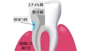 歯の根元のムシ歯：根面う蝕(イメージ図)
