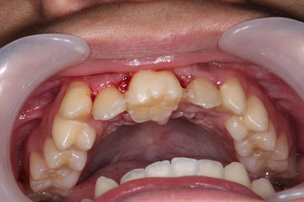 親知らずを前歯にできる 不可能と思われていた歯の移植手術が実現 ゆとり歯科医院 3d Ctと3dプリンターによる新たな歯牙移植治療を発表 ゆとり歯科医院のプレスリリース