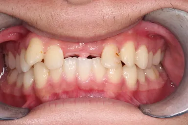 事故で前歯2本消失