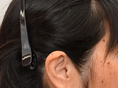 女性 Before(0ヶ月)