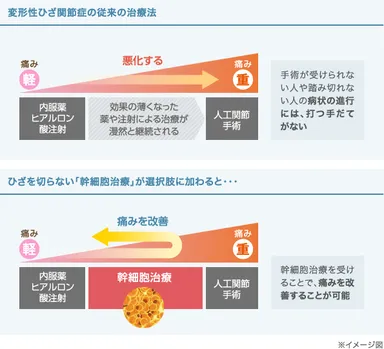 変形性ひざ関節症の従来の治療法／ひざを切らない幹細胞治療が選択肢に加わった場合
