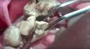 カナデ歯科　YouTube400万回再生大量歯石動画
